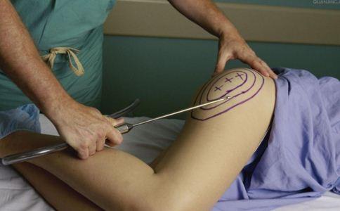 腿部吸脂分几个部位 吸对才能快速瘦 腿部吸脂分几个部位 腿部吸脂的方法有哪些 腿部吸脂有哪些优势