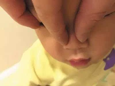 捏鼻梁让宝宝鼻子变挺？小心诱发2种病