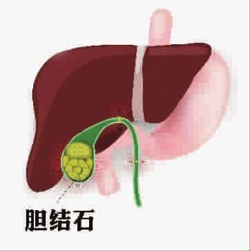 如何护理胆结石？高危人群要注意
