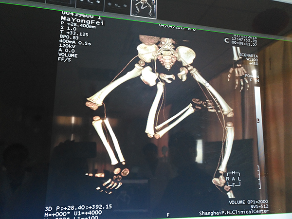 男婴出生时有三条腿和两个骨盆 医生:原本是双胞胎