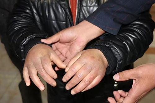 江苏一精神病人入院后遭粗暴约束 涉事护工被辞