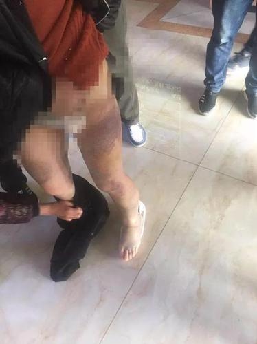 江苏一精神病人入院后遭粗暴约束 涉事护工被辞