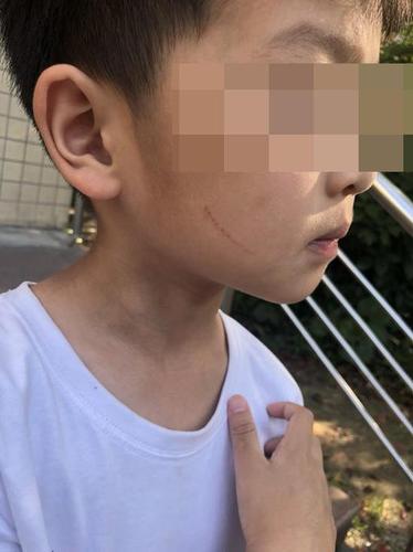 上海幼儿园多名孩子被划伤 疑似保育员所为