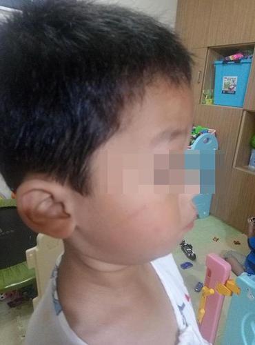 上海幼儿园多名孩子被划伤 疑似保育员所为