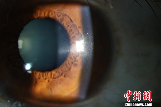 术后2年，患者角膜透明。供图