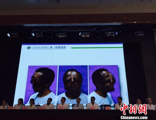 小伙患病貌似“狮面”，经手术重获新颜。　陈颖 摄
