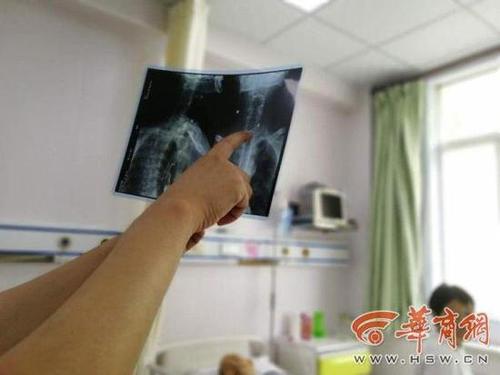 老汉吃粽子时听笑话 忍不住发笑枣核滑入卡住食道