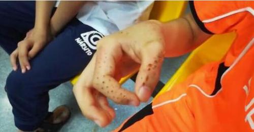 好痛！仙人掌从15楼砸下 男孩耳朵成“马蜂窝”