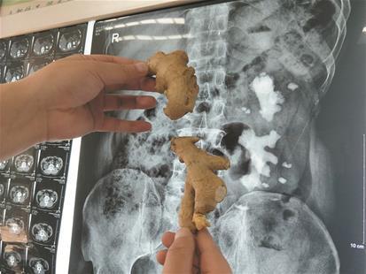 男子体内长出老“生姜” “巨无霸”结石塞满左肾