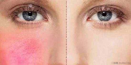 脸上红血丝形成的原因是什么？ 