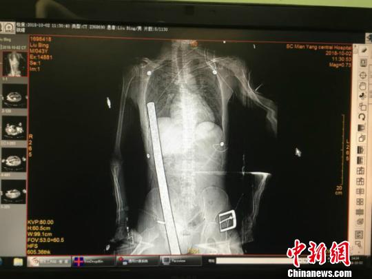 四川男子50厘米钢筋插进体内手术3小时成功取出