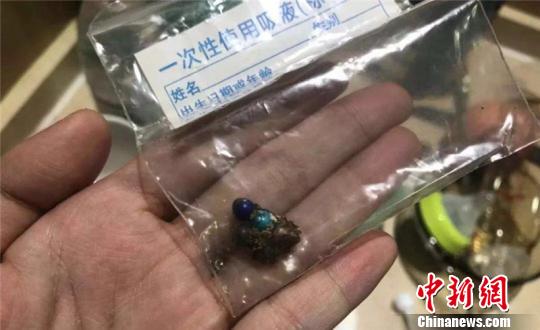 从患者体内取出的磁力珠，其中有3颗已经被肠液腐蚀发黑 浙江大学明州医院供图