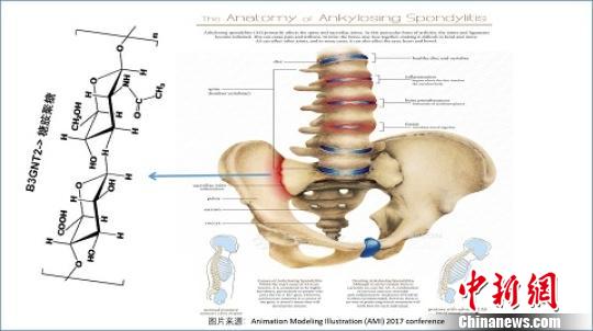 中国科学家等揭示汉族人群强直性脊柱炎关联基因