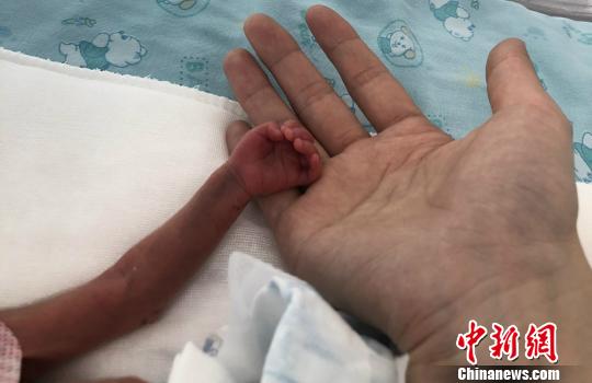 图为宝宝的小手。(院方供图) 张娅子 摄