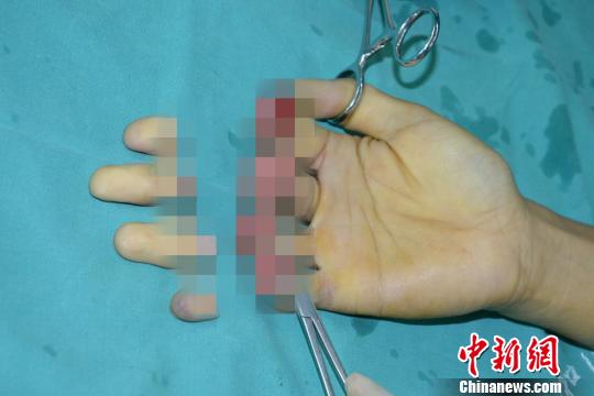 男子工作时被压断7根手指 马云飞 摄 男子工作时被压断7根手指 马云飞 摄