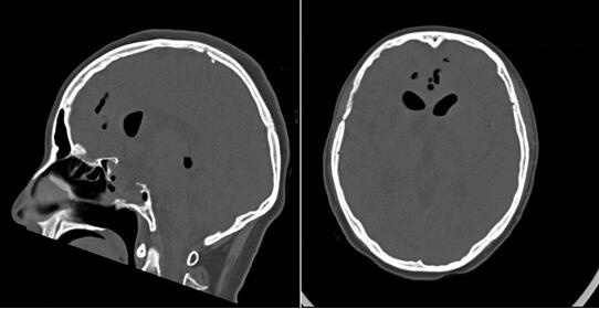 大脑里的液体从鼻腔流出怎么办 大脑里的液体从鼻腔流出怎么办
