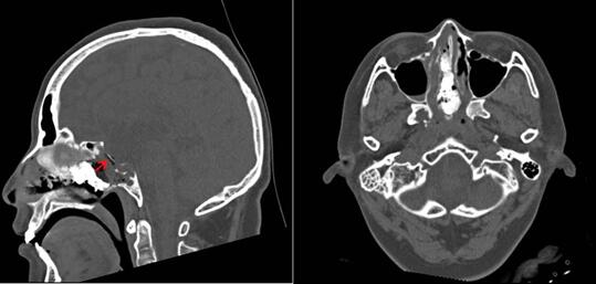 大脑里的液体从鼻腔流出怎么办 大脑里的液体从鼻腔流出怎么办