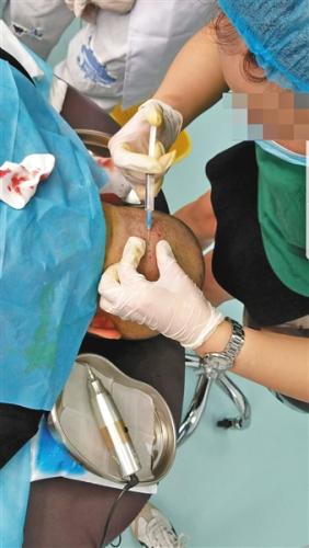 6月26日，北京源之美诊所，心理学出身的培训师焦老师正为学员示范注射头皮麻醉药。