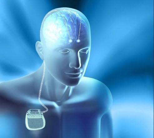 脑起搏器工作原理示意图 脑起搏器工作原理示意图